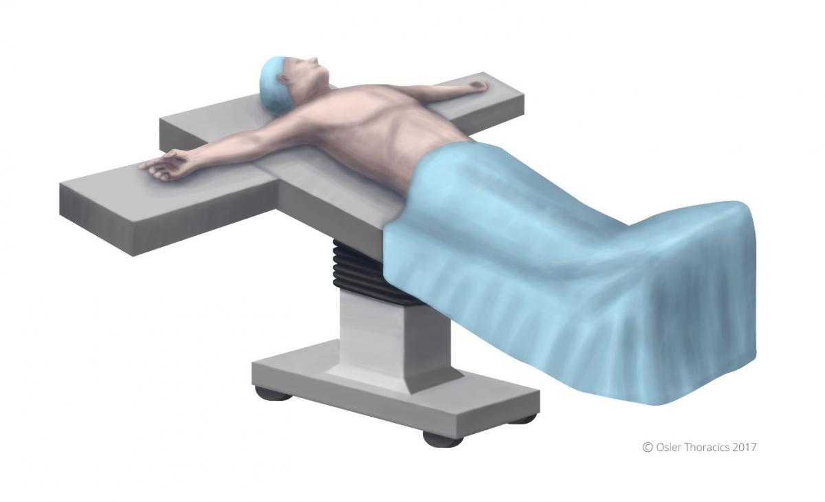 Bilateral VATS Endoscopic Thoracic Sympathectomy Toronto Sweat Clinic