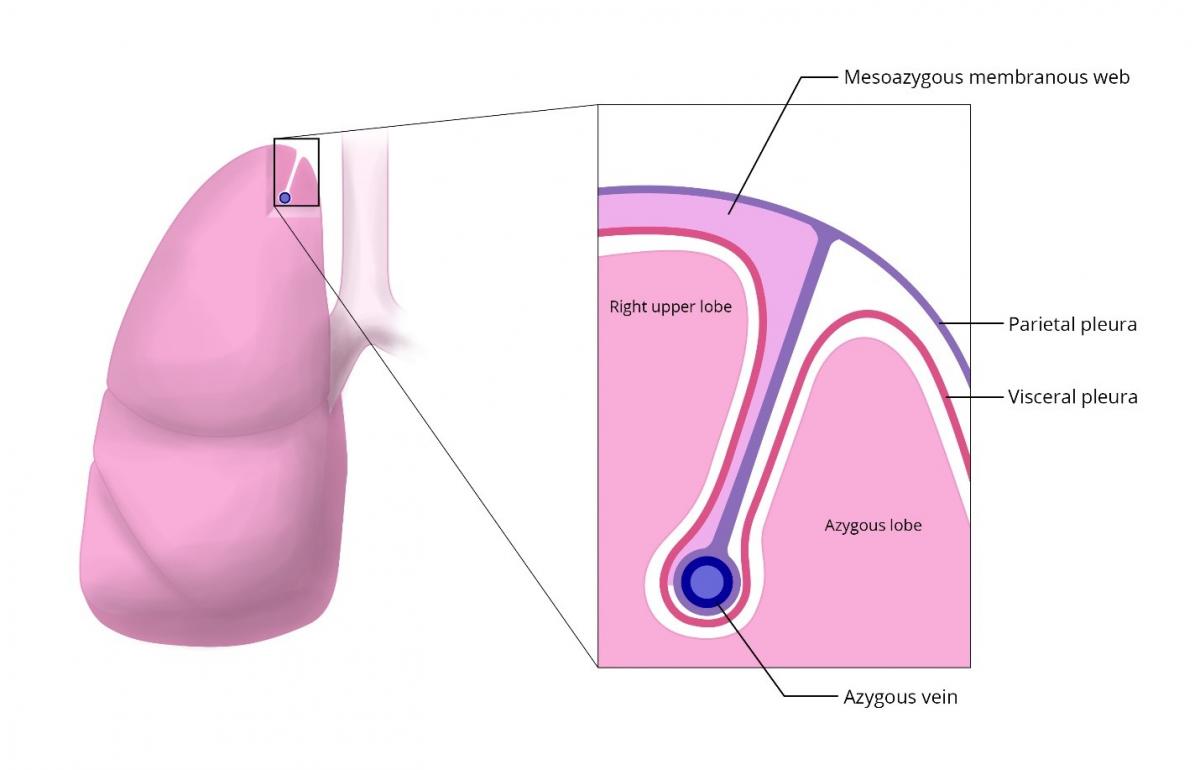 Bilateral VATS Endoscopic Thoracic Sympathectomy Toronto Sweat Clinic